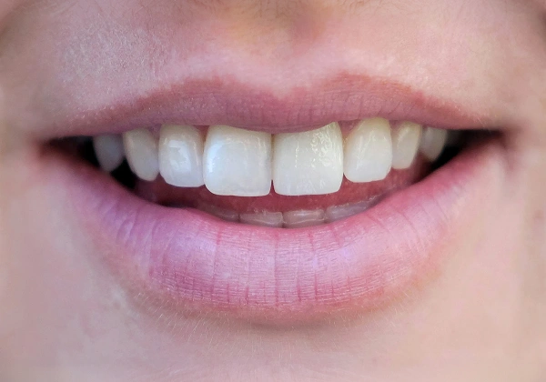 Teeth after treatment