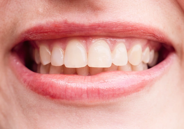 Smile after improvement