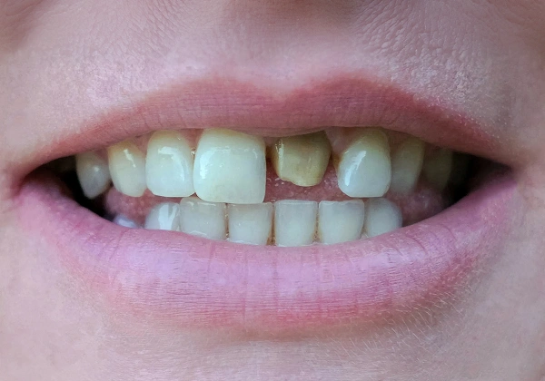 Teeth before treatment