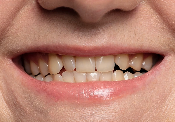 Smile before procedure