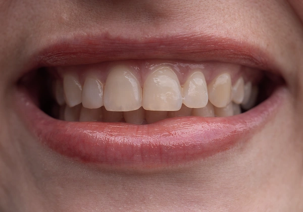 Smile before improvement