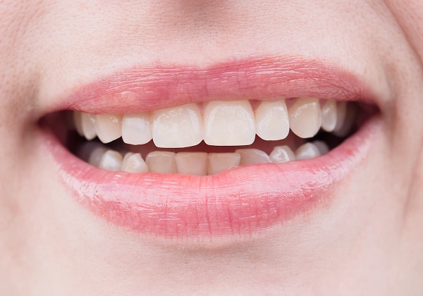 Teeth after treatment