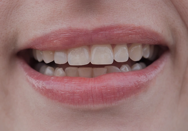 Teeth before treatment