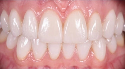 Teeth after treatment