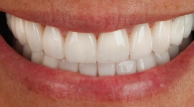 Teeth after treatment