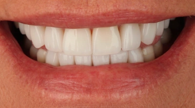 Teeth after treatment