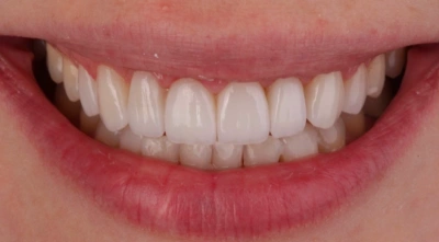 Teeth after treatment