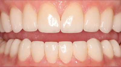 Teeth after treatment