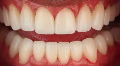 Teeth after treatment