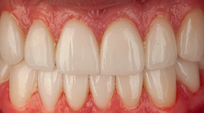 Teeth after treatment
