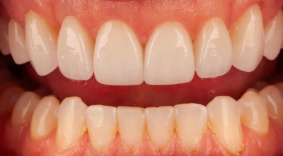 Teeth after treatment