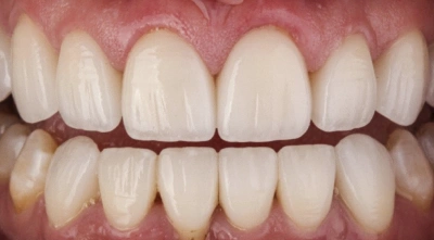 Teeth after treatment