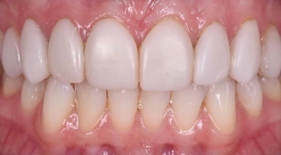 Teeth before treatment