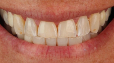 Teeth before treatment
