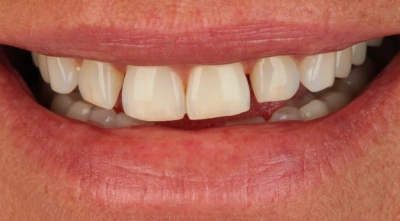 Teeth before treatment