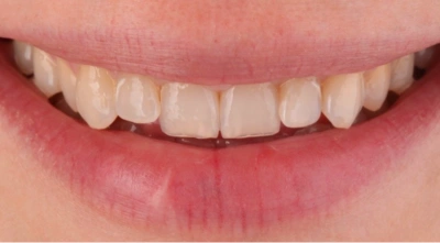 Teeth before treatment