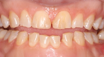 Teeth before treatment