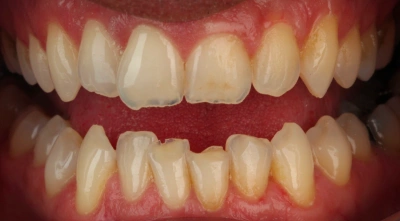 Teeth before treatment