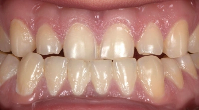 Teeth before treatment
