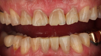 Teeth before treatment
