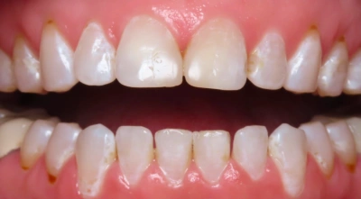Teeth before treatment