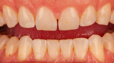 Teeth before treatment