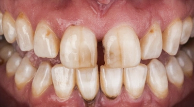 Teeth before treatment
