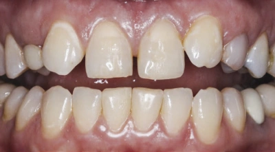 Teeth before treatment